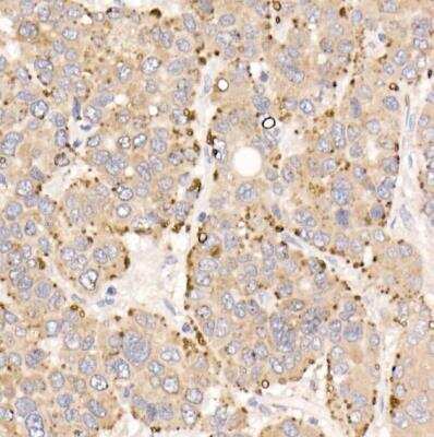 Immunohistochemistry-Paraffin: METTL7A Antibody [NBP3-04948] - Human liver cancer using METTL7A Rabbit pAb at dilution of 1:25 (40x lens).Perform high pressure antigen retrieval with 10 mM citrate buffer pH 6.0 before commencing with IHC staining protocol.