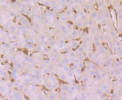 Immunohistochemistry-Paraffin: MGST3 Antibody [NBP2-75572] - Analysis of paraffin-embedded human liver cancer tissue using anti-GST3 antibody. Counter stained with hematoxylin.