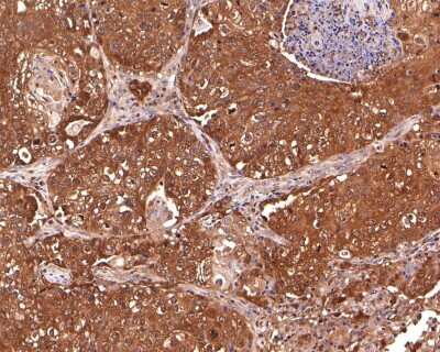 Immunohistochemistry-Paraffin: MGST3 Antibody (JB40-79) [NBP2-75573] - Analysis of paraffin-embedded human lung squamous carcinoma tissue with Rabbit anti-MGST3 antibody washed with ddH2O and PBS, and then probed with the primary antibody  at 1/500 dilution for 1 hour at room temperature. The detection was performed using an HRP conjugated compact polymer system. DAB was used as the chromogen. Tissues were counterstained with hematoxylin and mounted with DPX.