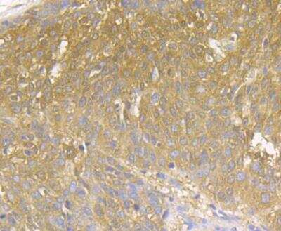 Immunohistochemistry: MICB Antibody [NBP2-76950] - Immunohistochemical analysis of paraffin-embedded human lung cancer tissue using anti-MICA + MICB antibody. The section was pre-treated using heat mediated antigen retrieval with Tris-EDTA buffer (pH 8.0-8.4) for 20 minutes.The tissues were blocked in 5% BSA for 30 minutes at room temperature, washed with ddH2O and PBS, and then probed with the antibody at 1/50 dilution, for 30 minutes at room temperature and detected using an HRP conjugated compact polymer system. DAB was used as the chrogen. Counter stained with hematoxylin and mounted with DPX.