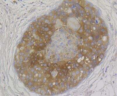 Immunohistochemistry: MICB Antibody [NBP2-76950] - Immunohistochemical analysis of paraffin-embedded human breast carcinoma tissue using anti-MICA + MICB antibody. The section was pre-treated using heat mediated antigen retrieval with Tris-EDTA buffer (pH 8.0-8.4) for 20 minutes.The tissues were blocked in 5% BSA for 30 minutes at room temperature, washed with ddH2O and PBS, and then probed with the antibody at 1/200 dilution, for 30 minutes at room temperature and detected using an HRP conjugated compact polymer system. DAB was used as the chrogen. Counter stained with hematoxylin and mounted with DPX.