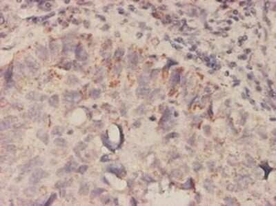 Immunohistochemistry-Paraffin: MIF Antibody (2A10-4D3) [H00004282-M01] - Analysis of monoclonal antibody to MIF on formalin-fixed paraffin-embedded human lung, adenosquamous cell carcinoma tissue. Antibody concentration 1 ~ 10 ug/ml.