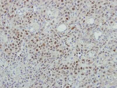Immunohistochemistry-Paraffin: MINA53 Antibody [NBP2-17292] - Immunohistochemical analysis of paraffin-embedded HBL435 xenograft, using antibody at 1:500 dilution.