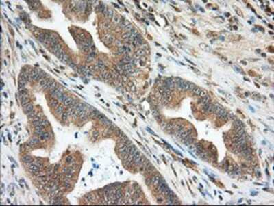 Immunohistochemistry-Paraffin: MIOX Antibody (4G7) [NBP2-02771] - Staining of paraffin-embedded Adenocarcinoma of Human colon tissue using anti-MIOX mouse monoclonal antibody.