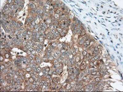 Immunohistochemistry-Paraffin: MIOX Antibody (4G7) [NBP2-02771] - Staining of paraffin-embedded Adenocarcinoma of Human ovary tissue using anti-MIOX mouse monoclonal antibody.
