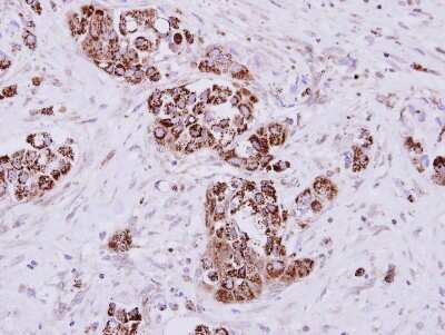 Immunohistochemistry-Paraffin: MIOX Antibody [NBP2-15030] - Paraffin-embedded Breast ca, using antibody at 1:500 dilution.
