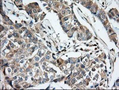 Immunohistochemistry: MIOX Antibody (OTI4G7) - Azide and BSA Free [NBP2-72697] - Staining of paraffin-embedded Adenocarcinoma of Human breast tissue using anti-MIOX mouse monoclonal antibody.