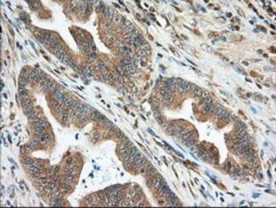 Immunohistochemistry: MIOX Antibody (OTI4G7) - Azide and BSA Free [NBP2-72697] - Staining of paraffin-embedded Adenocarcinoma of Human colon tissue using anti-MIOX mouse monoclonal antibody.
