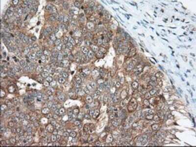 Immunohistochemistry: MIOX Antibody (OTI4G7) - Azide and BSA Free [NBP2-72697] - Staining of paraffin-embedded Adenocarcinoma of Human ovary tissue using anti-MIOX mouse monoclonal antibody.