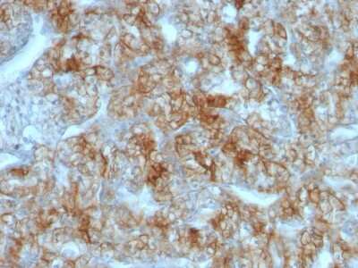 Immunohistochemistry-Paraffin: MITF Antibody (C5/D5) - IHC-Prediluted [NBP2-48263] - Formalin-fixed, paraffin-embedded human Renal Cell Carcinoma stained with KSP-Cadherin Mouse Monoclonal Antibody (CDH16/1071).