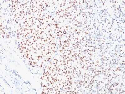 Immunohistochemistry-Paraffin: MITF Antibody (C5/D5) - IHC-Prediluted [NBP2-48263] - Human Melanoma stained with MITF Monoclonal Antibody (D5).