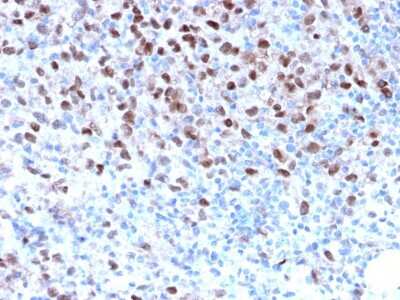 Immunohistochemistry-Paraffin: MITF Antibody (MITF/2987R) - Azide and BSA Free [NBP3-08590] - Formalin-fixed, paraffin-embedded human Melanoma stained with MITF Recombinant Rabbit Monoclonal Antibody (MITF/2987R).