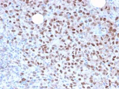 Immunohistochemistry-Paraffin: MITF Antibody (MITF/2987R) - Azide and BSA Free [NBP3-08590] - Formalin-fixed, paraffin-embedded human Melanoma stained with MITF Recombinant Rabbit Monoclonal Antibody (MITF/2987R).