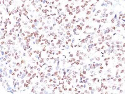 Immunohistochemistry-Paraffin: MITF Antibody (MITF/915) - IHC-Prediluted [NBP2-48280] - Human Melanoma stained with MITF Monoclonal Antibody (MITF/915).