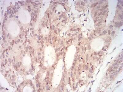 Immunohistochemistry: MKK3/MEK3 Antibody (2E12D11) [NBP2-52508] - Analysis of paraffin-embedded rectum cancer tissues using MAP2K3 mouse mAb with DAB staining.