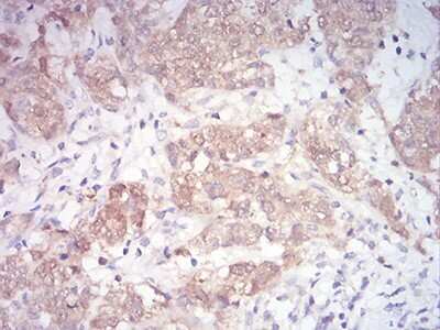 Immunohistochemistry-Paraffin: MKK3/MEK3 Antibody (2E12D11) [NBP2-52508] - Analysis of paraffin-embedded bladder cancer tissues using MAP2K3 mouse mAb with DAB staining.