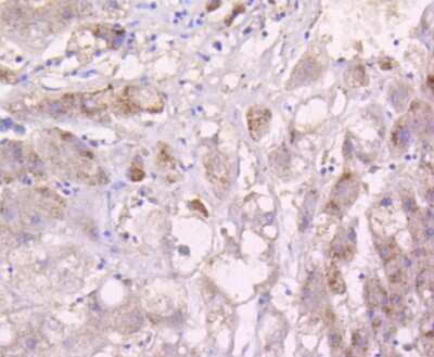 Immunohistochemistry-Paraffin: MKK3/MEK3 Antibody (SD20-93) [NBP2-67747] - Analysis of paraffin-embedded human breast carcinoma tissue using anti-MEK3 antibody. Counter stained with hematoxylin.
