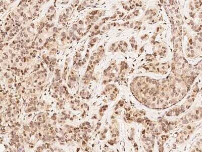 Immunohistochemistry-Paraffin: MKK4/MEK4 Antibody [NBP2-99331] - Immunochemical staining of human MKK4/MEK4 in human breast carcinoma with rabbit polyclonal antibody at 1:1000 dilution, formalin-fixed paraffin embedded sections.