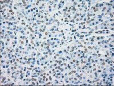 Immunohistochemistry: MKK4/MEK4 Antibody (OTI8A8) - Azide and BSA Free [NBP2-72710] - Staining of paraffin-embedded Carcinoma of Human thyroid tissue using anti-MEK4 mouse monoclonal antibody.