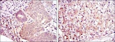 Immunohistochemistry: MKK6/MEK6 Antibody (3H12B9) [NBP2-37637] - Immunohistochemical analysis of paraffin-embedded ovarian cancer (left) and kidney cancer (right) using MAP2K6 mouse mAb with DAB staining.