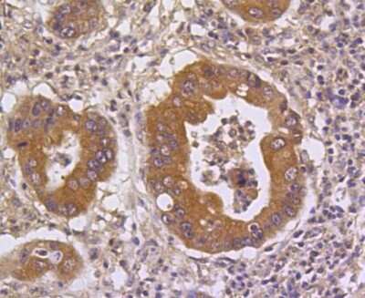 Immunohistochemistry-Paraffin: MKP-3/DUSP6 Antibody (SR39-09) [NBP2-67320] - Analysis of paraffin-embedded human gastric carcinoma tissue using anti-DUSP6 antibody. Counter stained with hematoxylin.