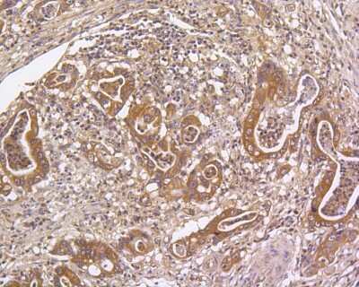 Immunohistochemistry-Paraffin: MKP-3/DUSP6 Antibody (SR39-09) [NBP2-67320] - Immunohistochemical analysis of paraffin-embedded human gastric carcinoma tissue using anti-MKP-3/DUSP6 antibody. The section was pre-treated using heat mediated antigen retrieval with Tris-EDTA buffer (pH 8.0-8.4) for 20 minutes. The tissues were blocked