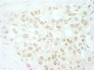 Immunohistochemistry-Paraffin: MKRN2 Antibody [NB100-55250] - Human breast carcinoma. Antibody: Affinity purified rabbit anti-MKRN2 used at a dilution of 1:1,000 (1ug/ml). Detection: DAB