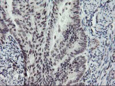 Immunohistochemistry-Paraffin: MLF2 Antibody (1E3) [NBP2-03726] - Staining of paraffin-embedded Adenocarcinoma of Human endometrium tissue using anti-MLF2 mouse monoclonal antibody.