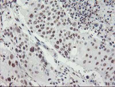 Immunohistochemistry-Paraffin: MLF2 Antibody (1E3) [NBP2-03726] - Staining of paraffin-embedded Carcinoma of Human lung tissue using anti-MLF2 mouse monoclonal antibody.