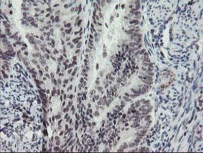 Immunohistochemistry: MLF2 Antibody (OTI1E3) - Azide and BSA Free [NBP2-72721] - Staining of paraffin-embedded Adenocarcinoma of Human endometrium tissue using anti-MLF2 mouse monoclonal antibody.