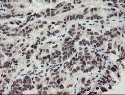 Immunohistochemistry: MLF2 Antibody (OTI1E3) - Azide and BSA Free [NBP2-72721] - Staining of paraffin-embedded Adenocarcinoma of Human ovary tissue using anti-MLF2 mouse monoclonal antibody.