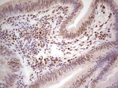 Immunohistochemistry: MLH1 Antibody (1C1) [NBP2-45882] - Analysis of Adenocarcinoma of Human colon tissue.