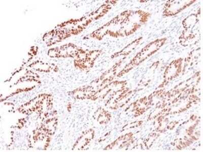 Immunohistochemistry-Paraffin: MLH1 Antibody (G168-728) [NBP3-07320] - Formalin-fixed, paraffin-embedded human colon carcinoma stained with MLH1 Mouse Monoclonal Antibody (G168-728).