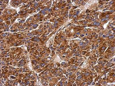 Immunohistochemistry-Paraffin: MMAB Antibody [NBP2-17308] - Immunohistochemical analysis of paraffin-embedded Hepatoma, using antibody at 1:500 dilution.