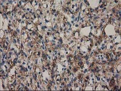 Immunohistochemistry: MMAB Antibody (OTI2G5) - Azide and BSA Free [NBP2-72730] - Staining of paraffin-embedded Carcinoma of Human kidney tissue using anti-MMAB mouse monoclonal antibody.