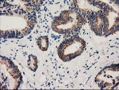 Immunohistochemistry: MMAB Antibody (OTI2G5) - Azide and BSA Free [NBP2-72730] - Staining of paraffin-embedded Carcinoma of Human prostate tissue using anti-MMAB mouse monoclonal antibody.