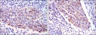 Immunohistochemistry-Paraffin: MMP-1 Antibody (6A5) - Azide and BSA Free [NBP2-80852] - Immunohistochemical analysis of paraffin-embedded human cervical cancer tissues (left) and human kidney cancer tissues (right) using MMP1 mouse mAb with DAB staining. Image from the standard format of this antibody.