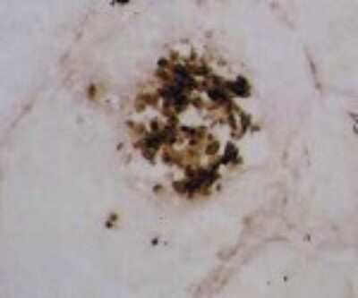 Immunohistochemistry: MMP-12 Antibody (603E6.22) [HRP] [DDX0280-HRPO-100] - Staining of human lung cancer frozen section.