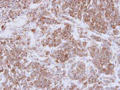 Immunohistochemistry-Paraffin: MMP-16/MT3-MMP Antibody [NBP1-33102] -  A549 xenograft , using MMP16 antibody at 1:100 dilution. Antigen Retrieval: Trilogy™ (EDTA based, pH 8.0) buffer, 15min. 