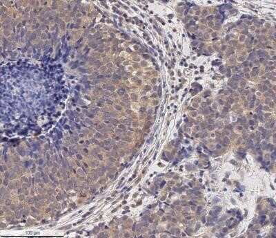 Immunohistochemistry: MMP-2 Antibody (2C1) - (Pro and Active) - Azide and BSA Free [NBP2-80853] - Analysis of a FFPE human breast cancer section using 5 ug/ml conc. of MMP2 antibody (clone 2C1) on a Bond Rx autostainer (Leica Biosystems). The assay involved 20 minutes of heat induced antigen retrieval (HIER) with 10mM sodium citrate buffer (pH 6.0) an