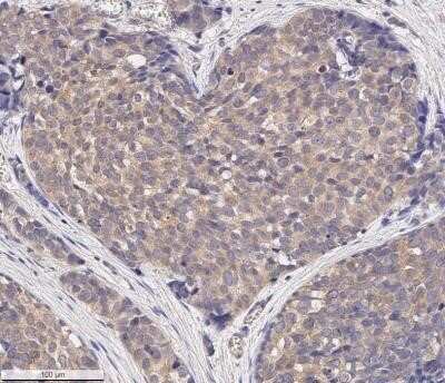 Immunohistochemistry-Paraffin: MMP-2 Antibody (2C1) - (Pro and Active) - Azide and BSA Free [NBP2-80853] - Analysis of a FFPE human breast cancer section using 5 ug/ml conc. of MMP2 antibody (clone 2C1) on a Bond Rx autostainer (Leica Biosystems). The assay involved 20 minutes of heat induced antigen retrieval (HIER) with 10mM sodium citrate buffer (pH 6.0) an