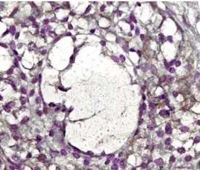 Immunohistochemistry: MMP-2 Antibody (8B4) - (Pro and Active) - Azide and BSA Free [NBP2-80854] - Detection of MMP-2 staining in FFPE human ovary tissue. Primary antibody was used at 2.5 ug/ml with the avidin-biotin-peroxidase detection method. Image from the standard format of this antibody.