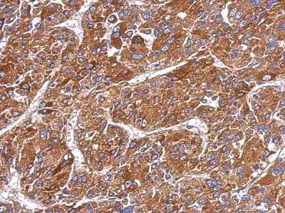 Immunohistochemistry-Paraffin: MMP8 Antibody [NBP2-17316] - Immunohistochemical analysis of paraffin-embedded Hepatoma, using antibody at 1:500 dilution.