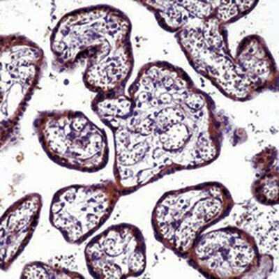 Immunohistochemistry-Paraffin: MMP9 Antibody [NB600-1217] - Human Breast Carcinoma stained with antibody.