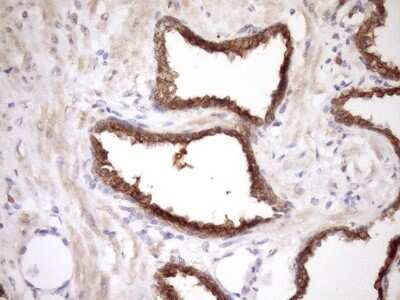 Immunohistochemistry: MRG15 Antibody (5D2) [NBP2-45908] - Analysis of Carcinoma of Human prostate tissue. (Heat-induced epitope retrieval by Tris-EDTA, pH8.0)