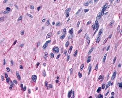 Immunohistochemistry-Paraffin: MRGPRF Antibody [NLS1983] - Analysis of anti-MRGPRF antibody with human brain, glioblastoma.