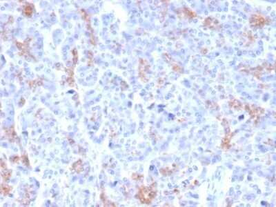 Immunohistochemistry-Paraffin: MRP3 Antibody (ABCC3/2971) - Azide and BSA Free [NBP2-79837] - Formalin-fixed, paraffin-embedded human Pancreatic Carcinoma stained with MRP3 Antibody (ABCC3/2971).