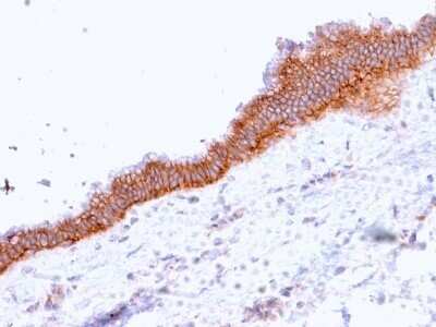 Immunohistochemistry-Paraffin: MRP3 Antibody (ABCC3/2971) - Azide and BSA Free [NBP2-79837] - Formalin-fixed, paraffin-embedded human Pancreatic Carcinoma stained with MRP3 Antibody (ABCC3/2971).