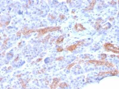 Immunohistochemistry-Paraffin: MRP3 Antibody (ABCC3/2971) - Azide and BSA Free [NBP2-79837] - Formalin-fixed, paraffin-embedded human Pancreatic Carcinoma stained with MRP3 Antibody (ABCC3/2971).