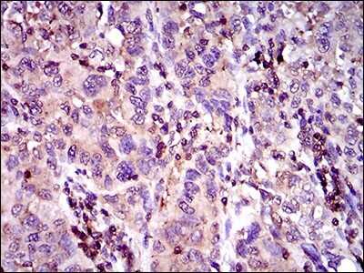 Immunohistochemistry-Paraffin: MRP4/ABCC4 Antibody (2D2A9) [NBP2-37350] - Analysis of endometrial cancer tissues using ABCC4 mouse mAb with DAB staining.